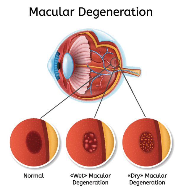 Age-Related Macular Degeneration Image