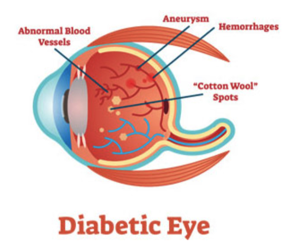 Diabetic Eye Image