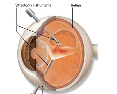 Vitrectomy (Retinal Surgery)